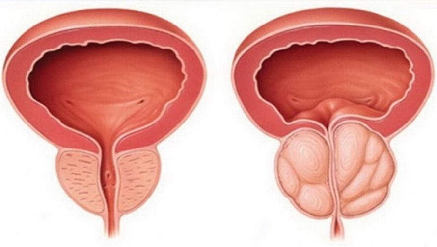 osasuntsu eta hanturatutako prostata prostatitisarekin