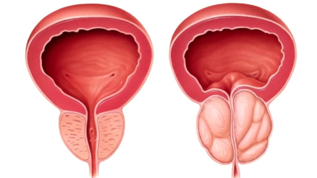 prostata osasuntsua eta gaixoa