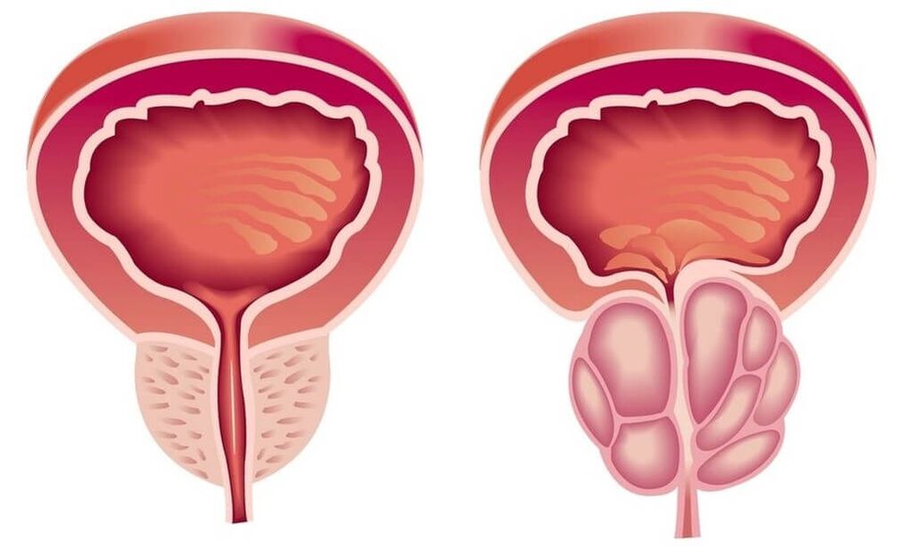 prostata osasuntsua eta gaixoa